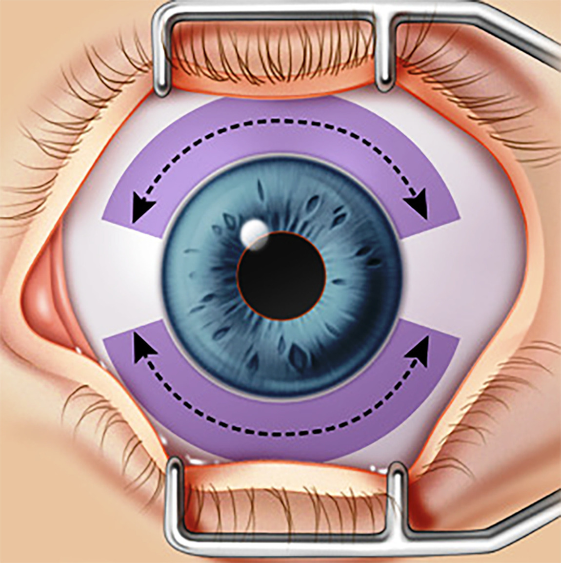 Проекция цилиарного тела на склеру глаза (область операции)