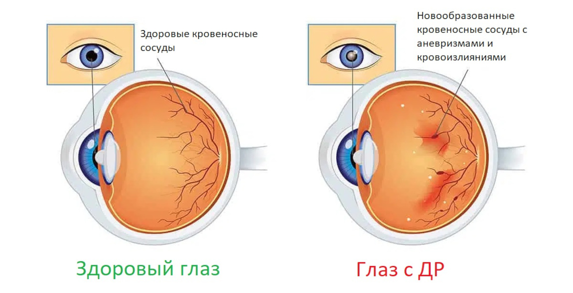Здоровый глаз и глаз с диабетической ретинопатией