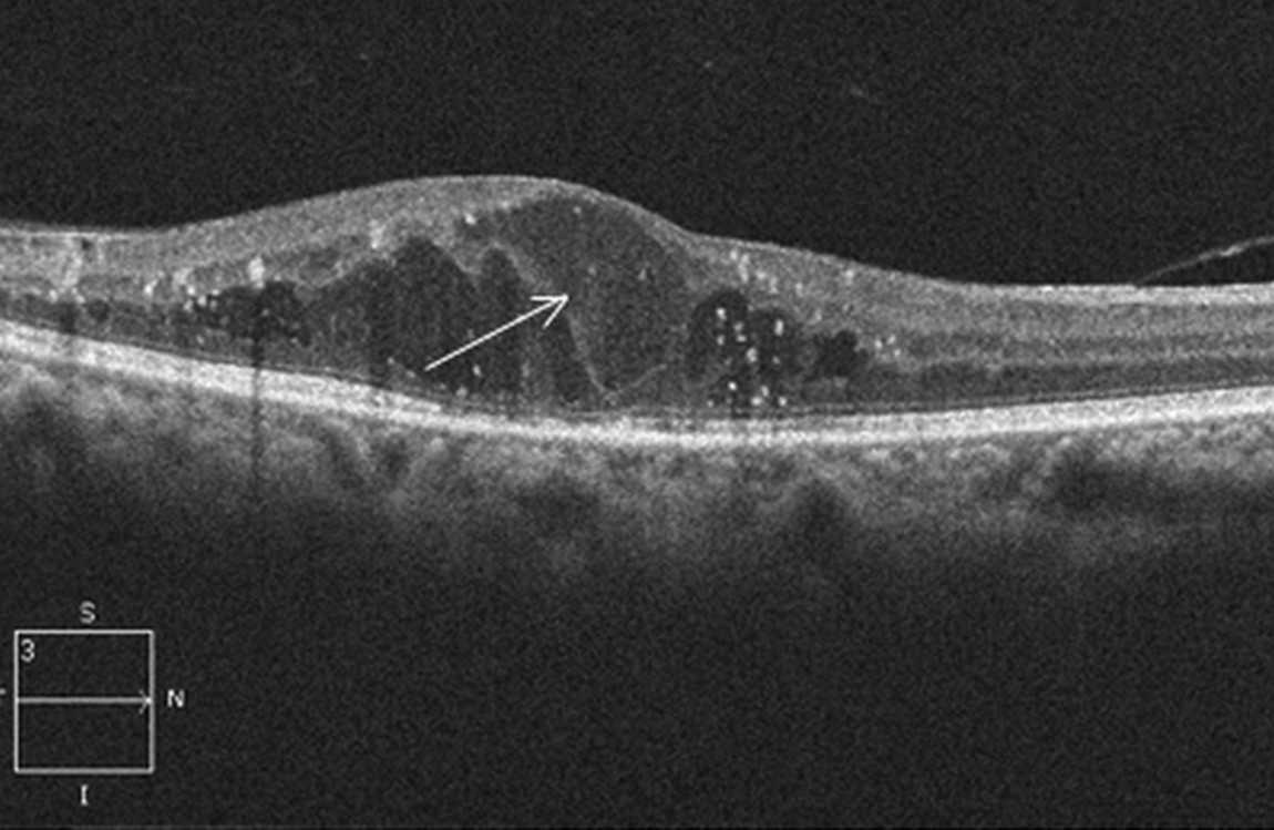 Снимок ОКТ сетчатки при диабетической ретинопатии