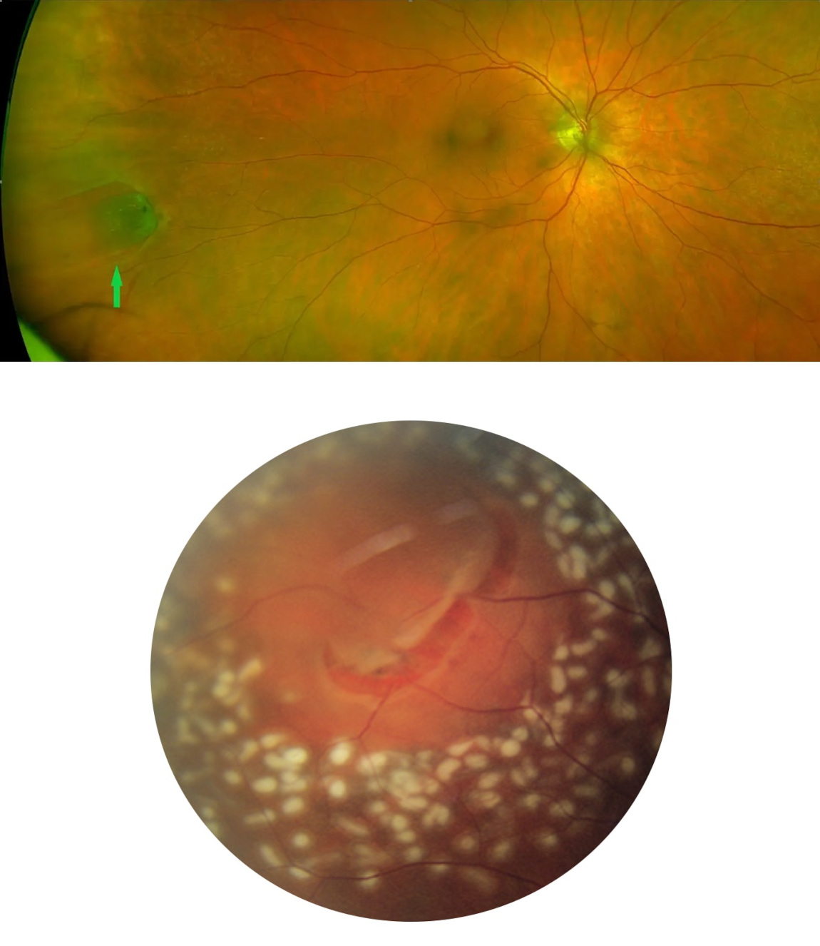 Фотография глазного дна до и после коагуляции при разрыве сетчатки