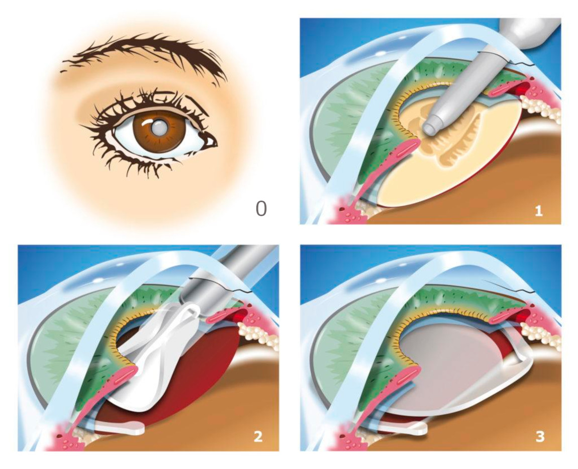 Этапы операции по удалению катаракты методом факоэмульсификации