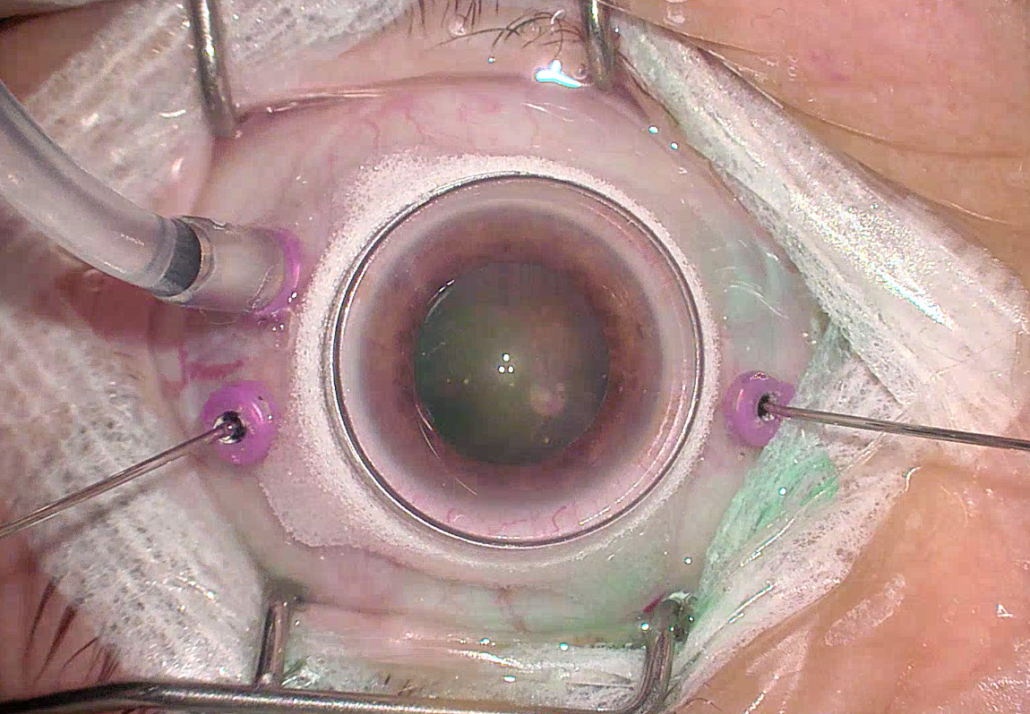 Глаз во время операции витрэктомии при отслойке сетчатки