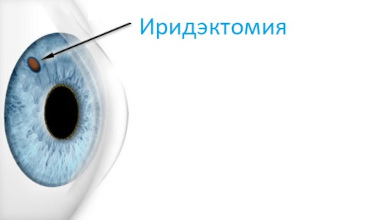 Лазерная иридэктомия при глаукоме