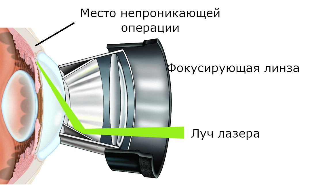 Лазерная десцеметогониопунктура (ЛДГП) при глаукоме