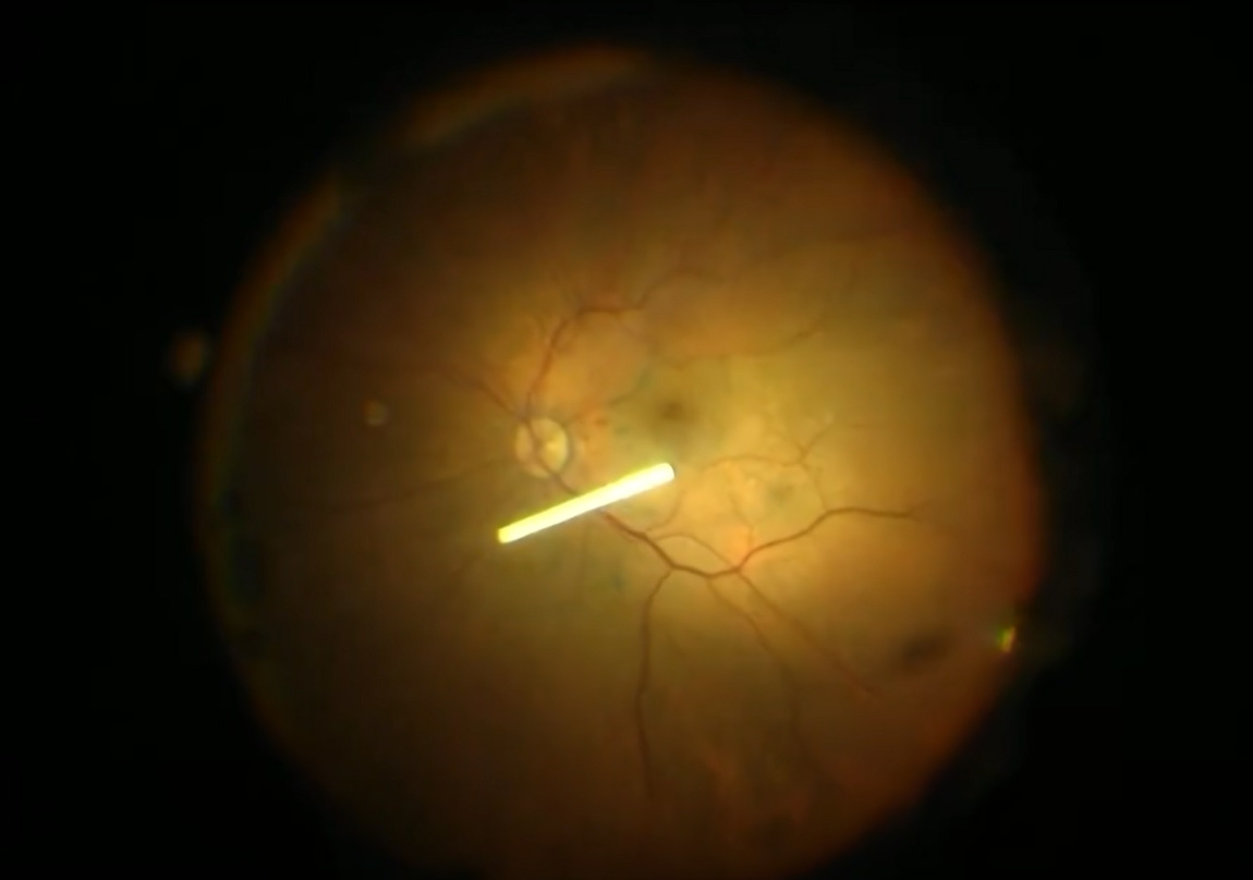 Имплант Озурдекс на глазном дне после введения
