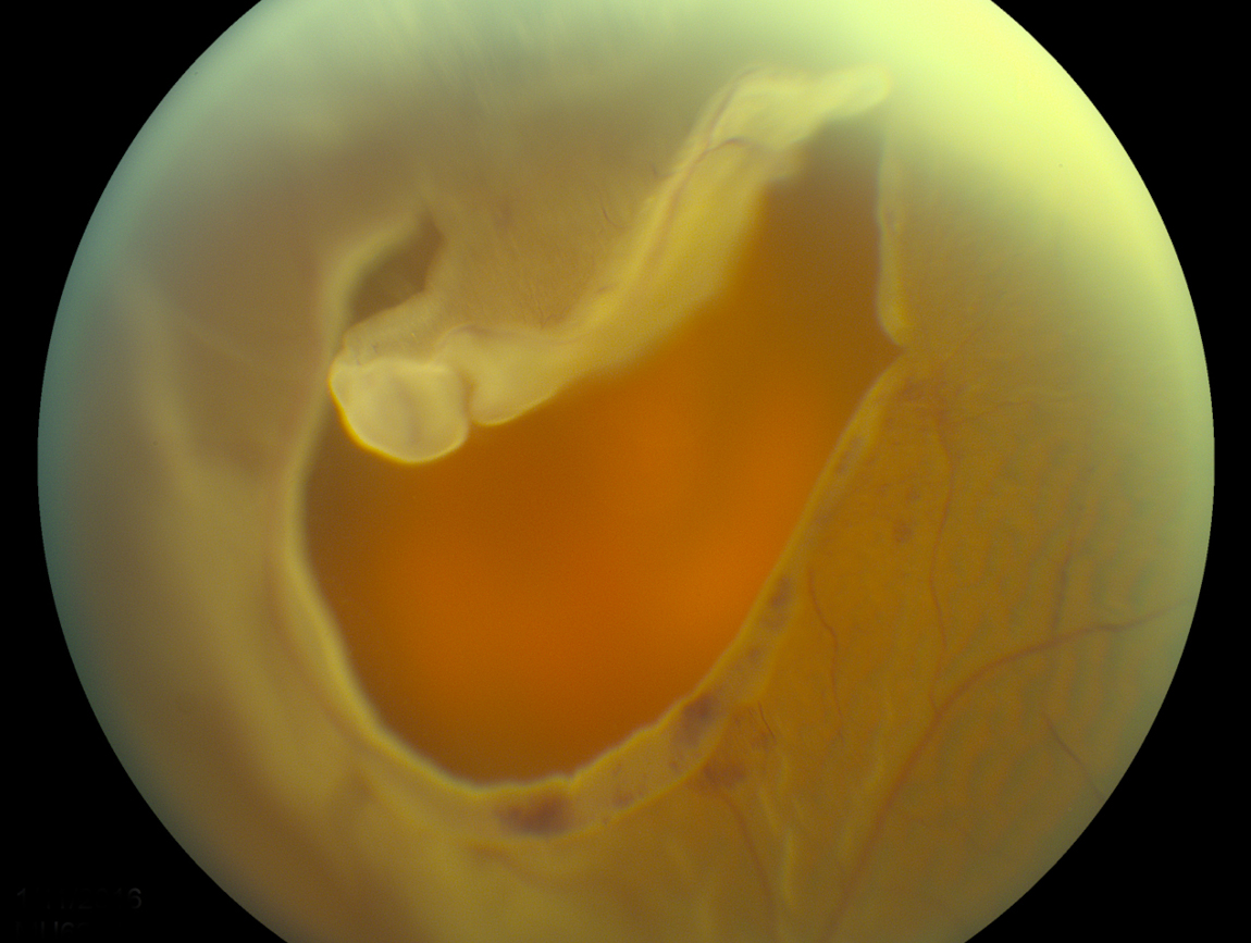 Глазное дно при офтальмоскопии - разрыв и отслойка сетчатки