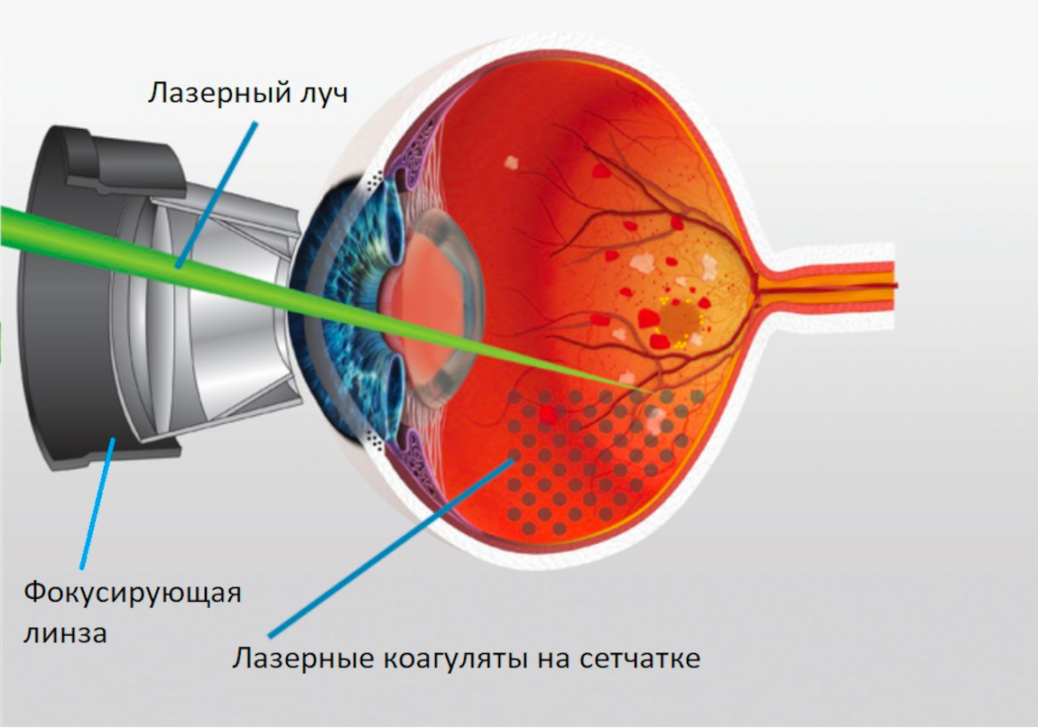Лазерная коагуляция сетчатки в Москве