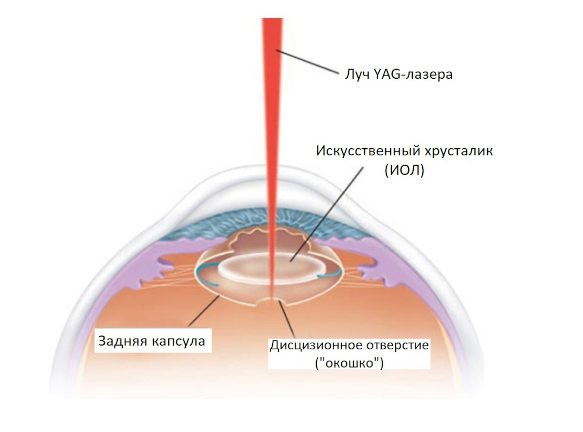 YAG-лазерная дисцизия вторичной катаракты в Москве