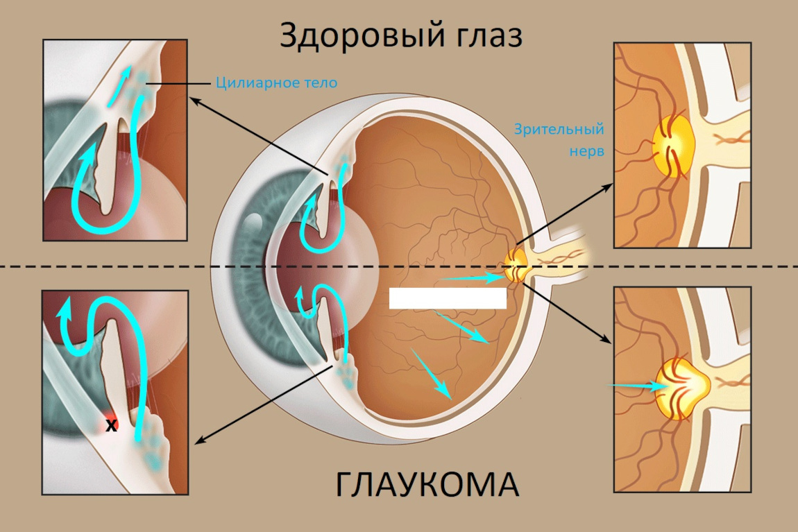 Ток внутриглазной жидкости при глаукоме и в здоровом глазу